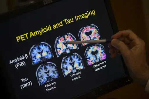 A doctor points to PET scan results that are part of a study on Alzheimer's disease at Georgetown University Hospital, on Tuesday, May 19, 2015, in Washington. (AP Photo/Evan Vucci, File)